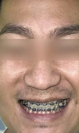 จัดฟันร่วมกับผ่าตัดขากรรไกร ตั้งแต่เริ่มจนจบ — ใบหน้า หลัง
