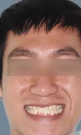จัดฟันร่วมกับผ่าตัดขากรรไกร ตั้งแต่เริ่มจนจบ — ใบหน้า ก่อน