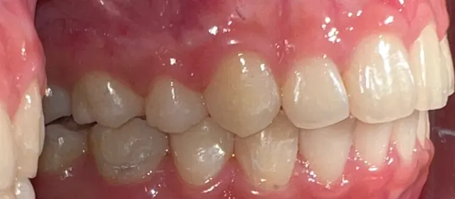 Buck teeth retracted for a more balanced profile — Side view (other side) After