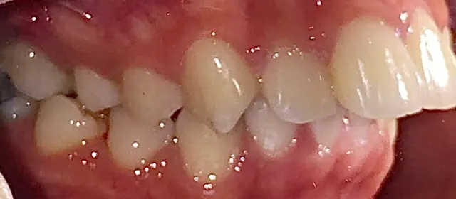 Buck teeth retracted for a more balanced profile — Side view (other side) Before