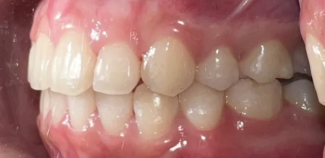 Buck teeth retracted for a more balanced profile — Side view After