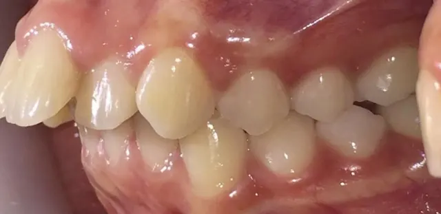 Buck teeth retracted for a more balanced profile — Side view Before