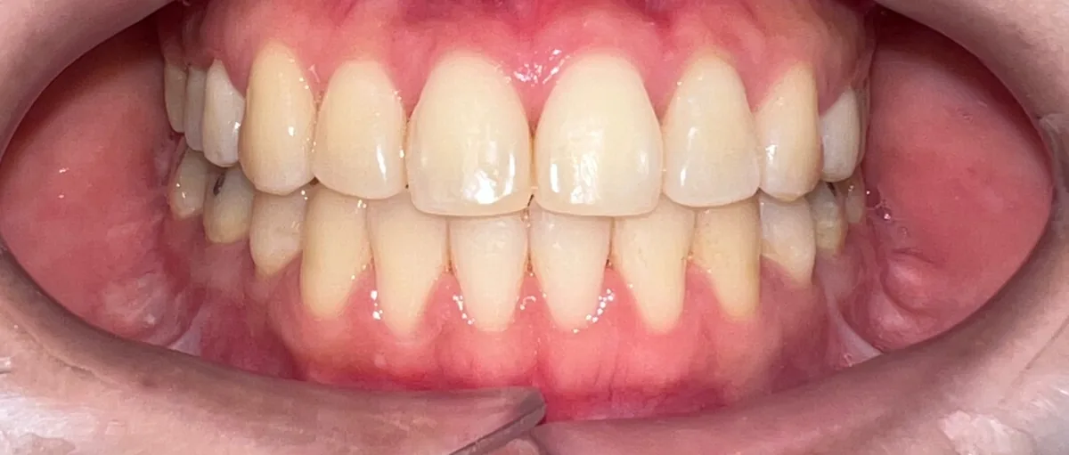 Crowded front teeth, aligned into an even bite — Front view After