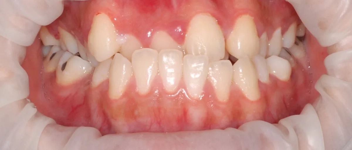Crowded front teeth, aligned into an even bite — Front view Before