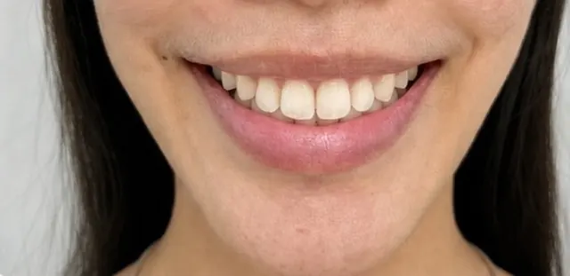 ยิ้มเห็นเหงือก แก้ไขร่วมกับการจัดฟัน — รอยยิ้ม หลัง