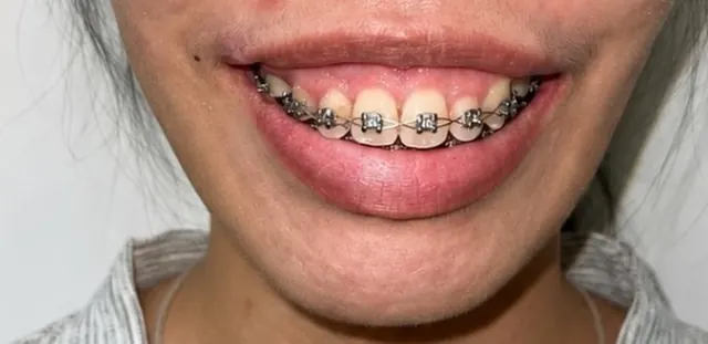 ยิ้มเห็นเหงือก แก้ไขร่วมกับการจัดฟัน — รอยยิ้ม ก่อน