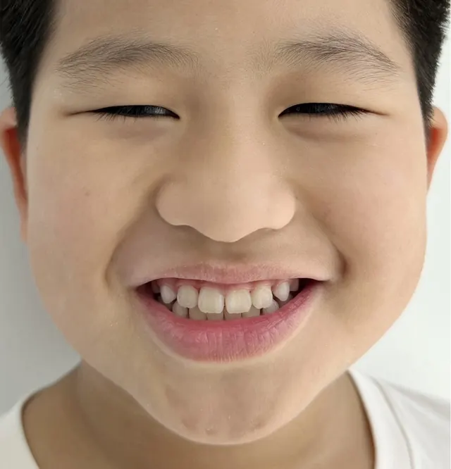 ฟันหน้าสบคร่อมในเด็ก แก้ด้วย Invisalign First — ใบหน้า หลัง