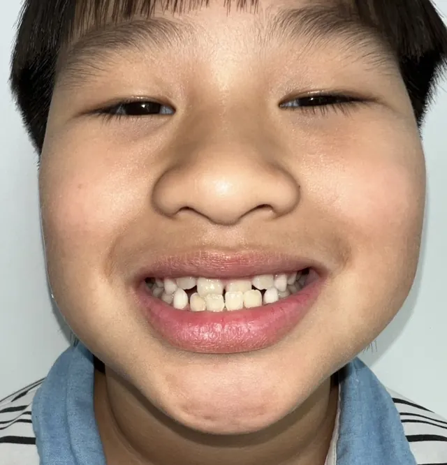 ฟันหน้าสบคร่อมในเด็ก แก้ด้วย Invisalign First — ใบหน้า ก่อน
