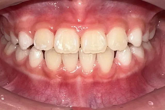 ฟันหน้าสบคร่อมในเด็ก แก้ด้วย Invisalign First — ด้านหน้า หลัง