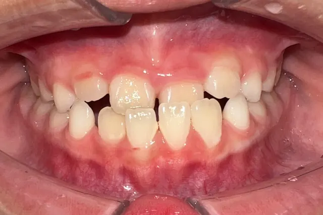 ฟันหน้าสบคร่อมในเด็ก แก้ด้วย Invisalign First — ด้านหน้า ก่อน