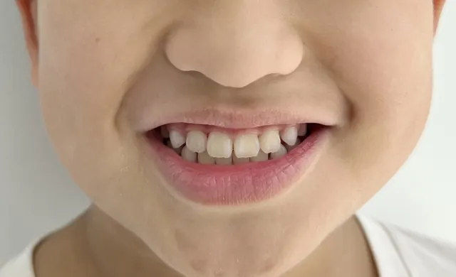 ฟันหน้าสบคร่อมในเด็ก แก้ด้วย Invisalign First — รอยยิ้ม หลัง