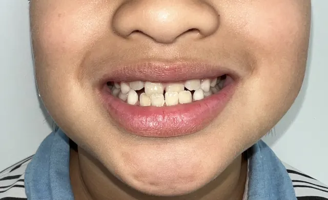 ฟันหน้าสบคร่อมในเด็ก แก้ด้วย Invisalign First — รอยยิ้ม ก่อน