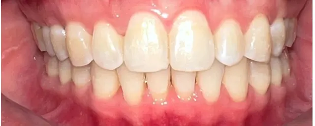 ฟันยื่น แก้ด้วย Invisalign โดยไม่ถอนฟัน — ด้านหน้า หลัง