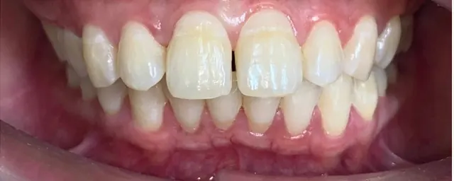 ฟันยื่น แก้ด้วย Invisalign โดยไม่ถอนฟัน — ด้านหน้า ก่อน
