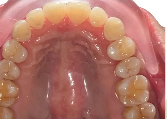 ฟันยื่น แก้ด้วย Invisalign โดยไม่ถอนฟัน — ด้านบดเคี้ยว หลัง