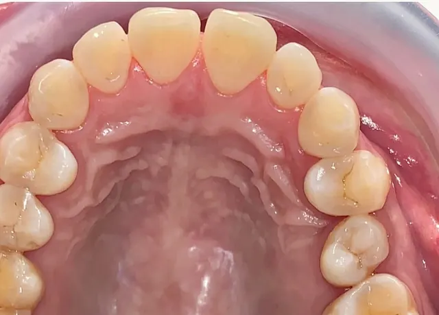 ฟันยื่น แก้ด้วย Invisalign โดยไม่ถอนฟัน — ด้านบดเคี้ยว ก่อน