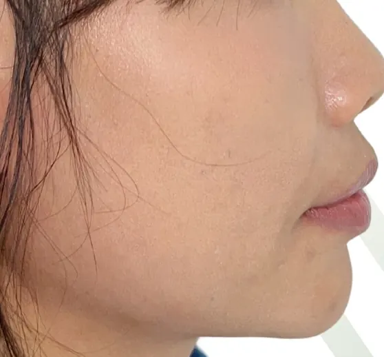 ฟันยื่น แก้ด้วย Invisalign โดยไม่ถอนฟัน — ด้านข้างใบหน้า หลัง