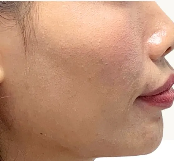 ฟันยื่น แก้ด้วย Invisalign โดยไม่ถอนฟัน — ด้านข้างใบหน้า ก่อน