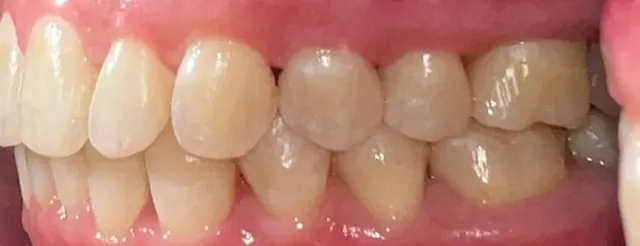 ฟันยื่น แก้ด้วย Invisalign โดยไม่ถอนฟัน — ด้านข้าง หลัง
