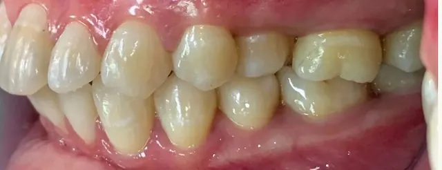 ฟันยื่น แก้ด้วย Invisalign โดยไม่ถอนฟัน — ด้านข้าง ก่อน