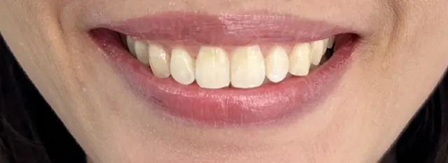 ฟันยื่น แก้ด้วย Invisalign โดยไม่ถอนฟัน — รอยยิ้ม หลัง