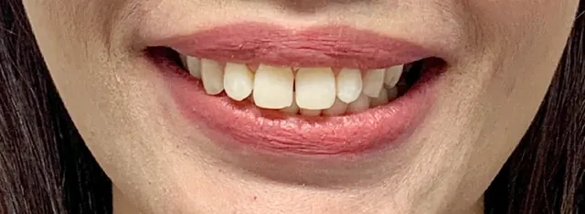 ฟันยื่น แก้ด้วย Invisalign โดยไม่ถอนฟัน — รอยยิ้ม ก่อน