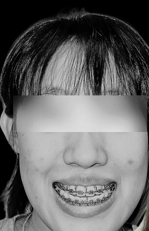 จัดฟันร่วมกับผ่าตัดขากรรไกร ทั้งการสบฟันและความมั่นใจ — ใบหน้า ก่อน