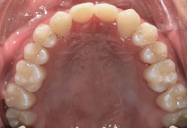 Closing the spaces of two missing lateral incisors — Occlusal view After