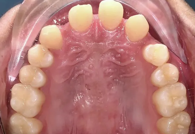 Closing the spaces of two missing lateral incisors — Occlusal view Before