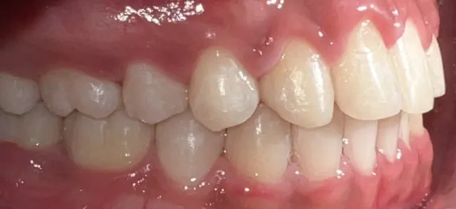 Closing the spaces of two missing lateral incisors — Side view (other side) After