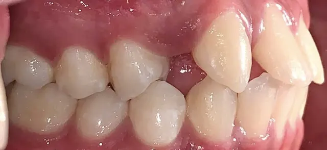 Closing the spaces of two missing lateral incisors — Side view (other side) Before