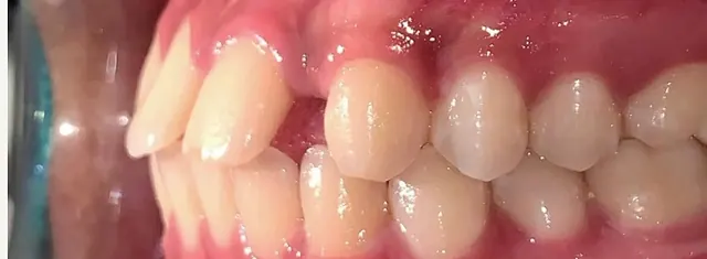 ปิดช่องว่างจากฟันตัดซี่ข้างหายไปสองซี่ — ด้านข้าง ก่อน