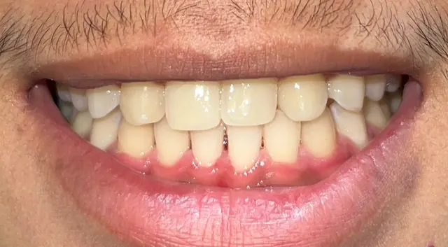Closing the spaces of two missing lateral incisors — Smile After