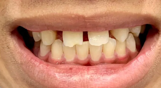 Closing the spaces of two missing lateral incisors — Smile Before