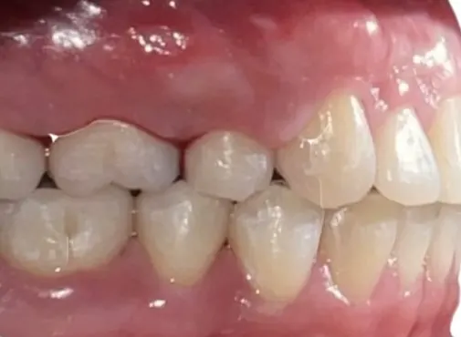 ออกแบบรอยยิ้มใหม่ แก้ฟันยื่นและเส้นโค้งรอยยิ้มที่ย้อนกลับ — ด้านข้าง หลัง