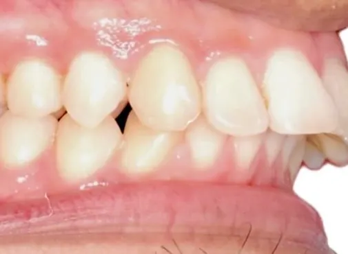 ออกแบบรอยยิ้มใหม่ แก้ฟันยื่นและเส้นโค้งรอยยิ้มที่ย้อนกลับ — ด้านข้าง ก่อน
