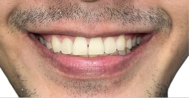 ออกแบบรอยยิ้มใหม่ แก้ฟันยื่นและเส้นโค้งรอยยิ้มที่ย้อนกลับ — รอยยิ้ม หลัง