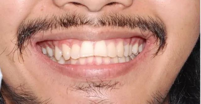 ออกแบบรอยยิ้มใหม่ แก้ฟันยื่นและเส้นโค้งรอยยิ้มที่ย้อนกลับ — รอยยิ้ม ก่อน
