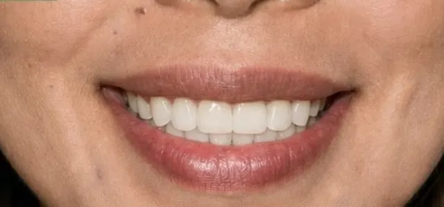 จัดฟันแล้วกล้ายิ้มได้เต็มที่ — รอยยิ้ม หลัง