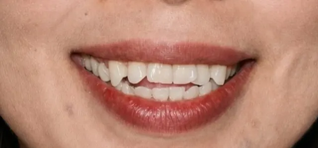 จัดฟันแล้วกล้ายิ้มได้เต็มที่ — รอยยิ้ม ก่อน