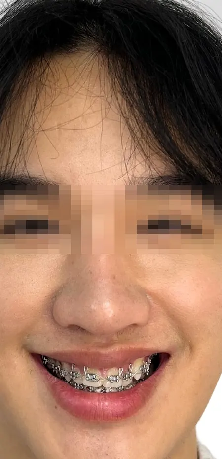 จัดฟันเพื่อปรับโครงหน้า แบบผ่าตัดก่อน — ใบหน้า หลัง