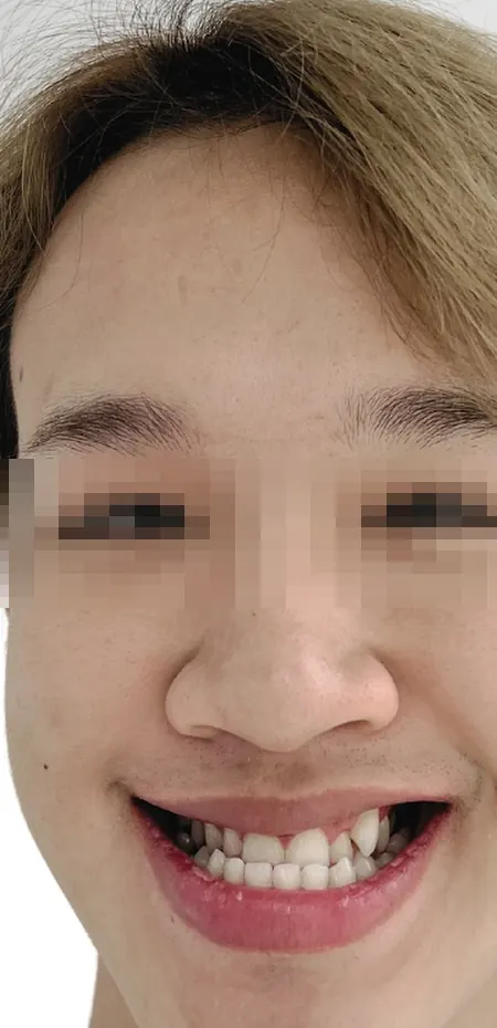 จัดฟันเพื่อปรับโครงหน้า แบบผ่าตัดก่อน — ใบหน้า ก่อน