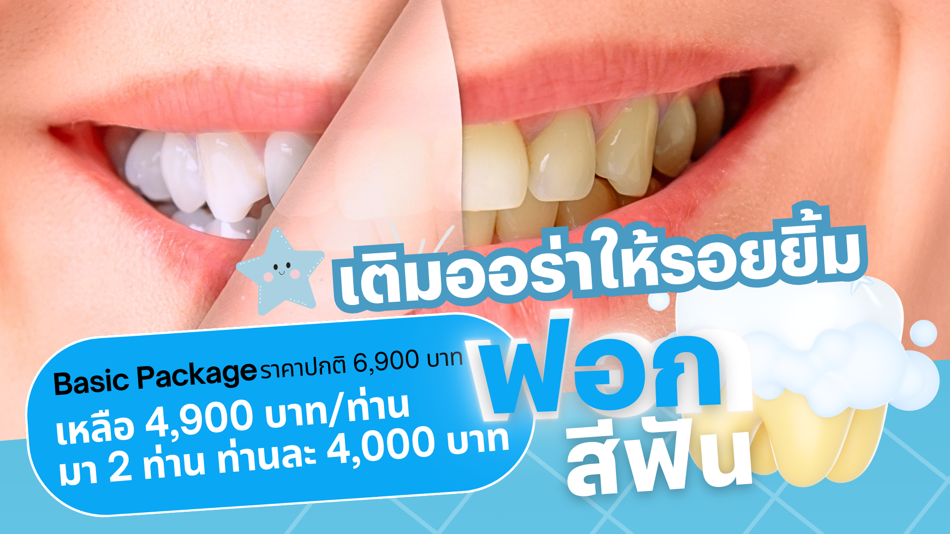 Teeth Whitening Basic Package – Tooth Boutique Dental, Watcharapol