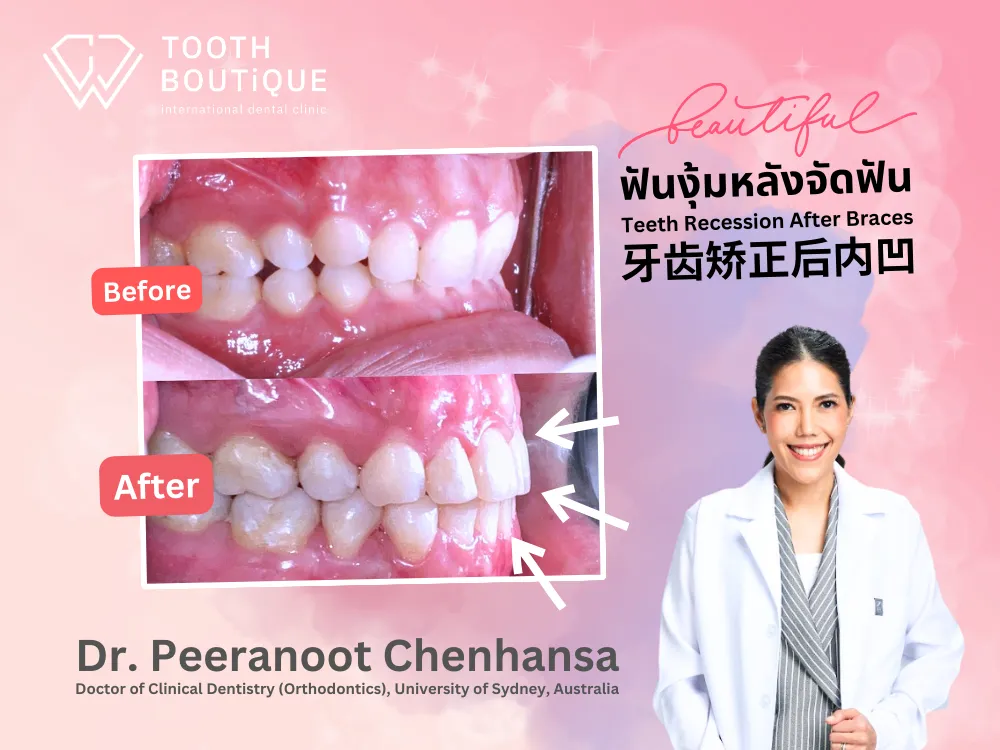 ฟันงุ้มหลังจัดฟัน